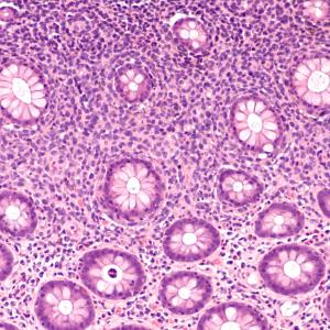 Pola-R-CHP triumphs over R-CHOP in improving PFS in DLBCL