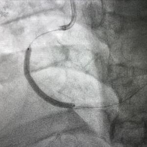 Post-PCI bivalirudin infusion reduces death, bleeding vs heparin