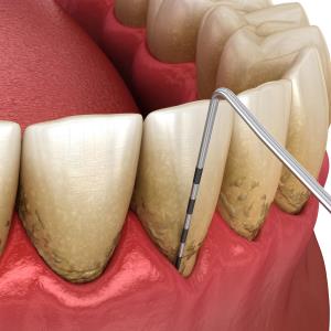 PPI use tied to less severe gum disease