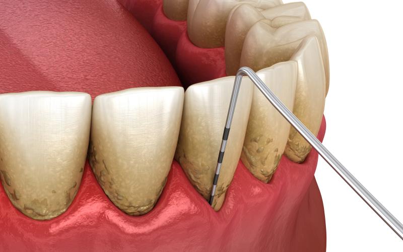 PPI use tied to less severe gum disease