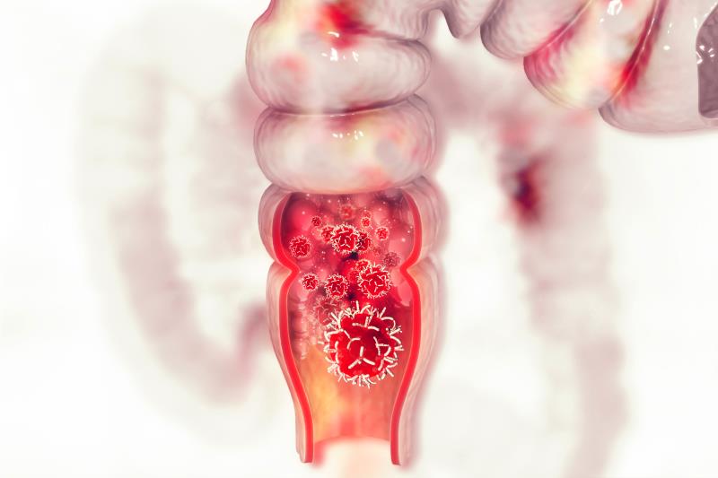 PRECONNECT final analysis underline potential of trifluridine/tipiracil for metastatic CRC