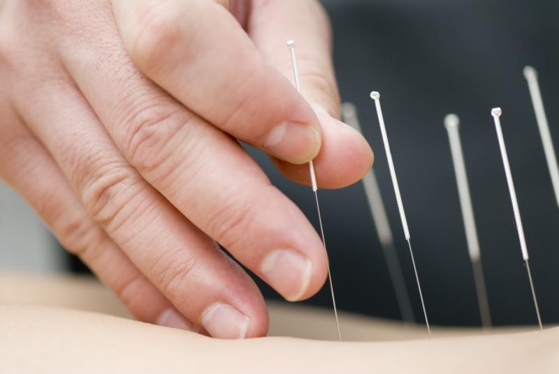 Acupuncture treatment has been growing in popularity in women trying to conceive.