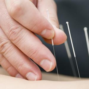 Acupuncture affects experimental dental pain