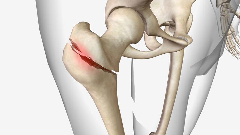 Preop skin antiseptic in fracture fixation: Which is better?