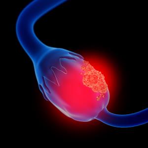 Subgroup findings boost benefit of niraparib in newly-diagnosed ovarian cancer