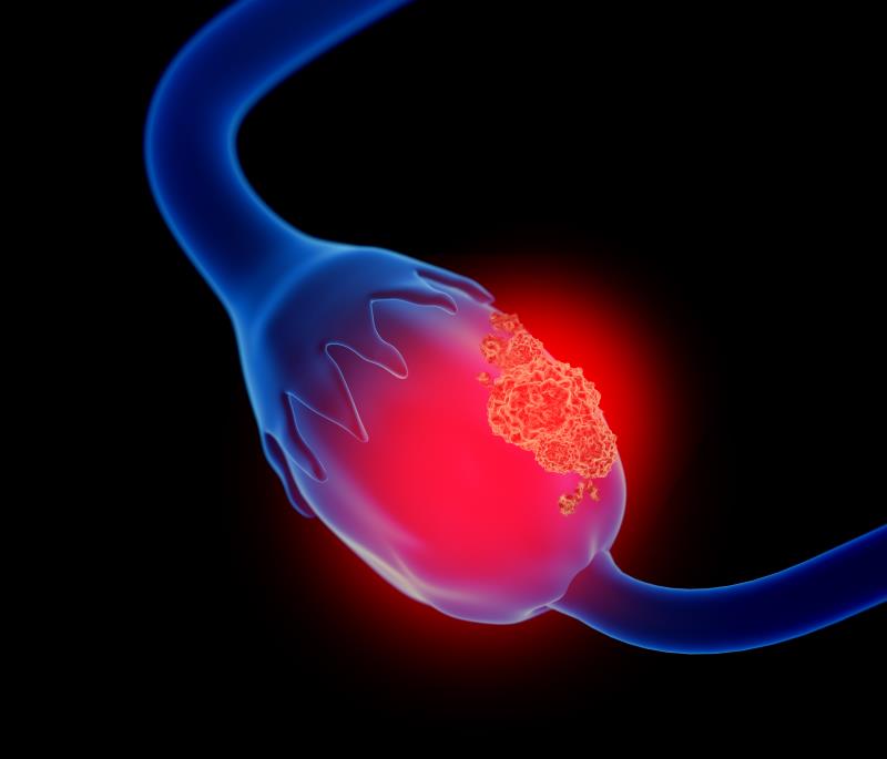 Subgroup findings boost benefit of niraparib in newly-diagnosed ovarian cancer