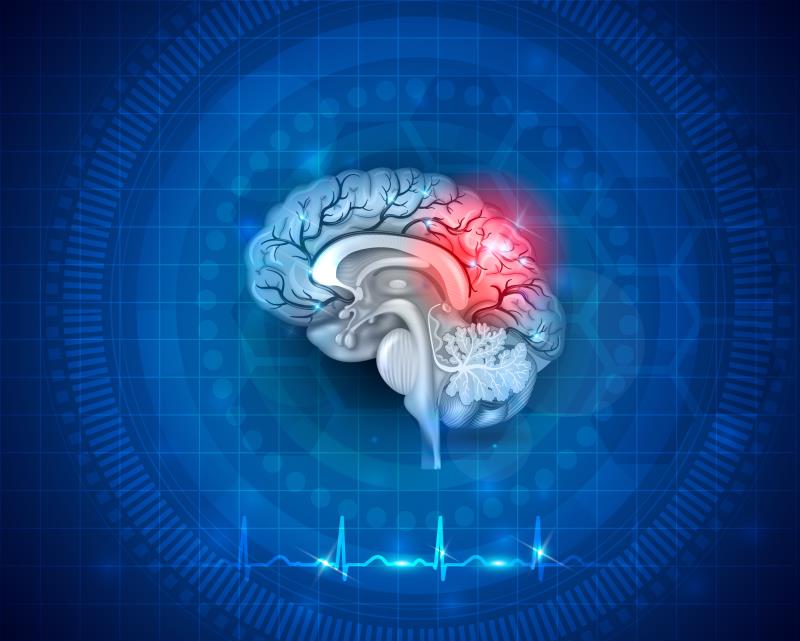 T2D drug may assist in stroke prevention after minor stroke, high-risk TIA
