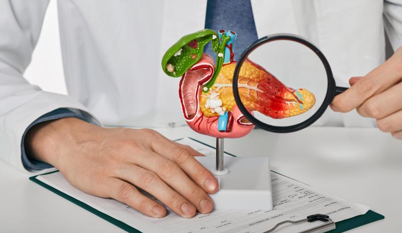 Indomethacin plus somatostatin helps avert pancreatitis in ERCP patients