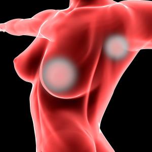 Risk of nonkeratinocyte skin cancers postradiotherapy high among breast cancer patients