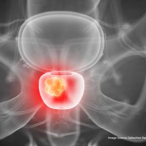 Benign prostatic hyperplasia on the rise, surgical interventions declining