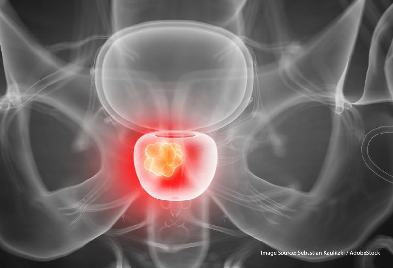 Benign prostatic hyperplasia on the rise, surgical interventions declining