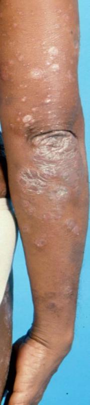 Psoriasis affecting the upper limb