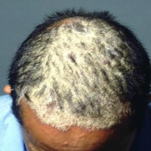 Apremilast proven effective in severe scalp psoriasis