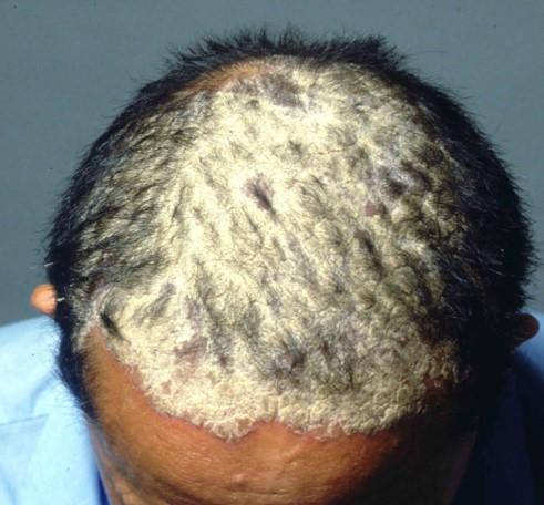 Psoriasis of the scalp