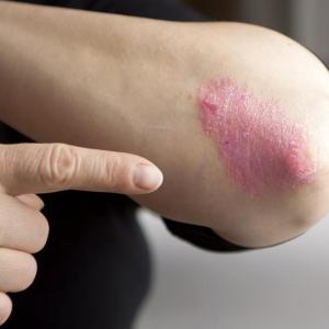 Biologics show promise in treatment of erythrodermic psoriasis