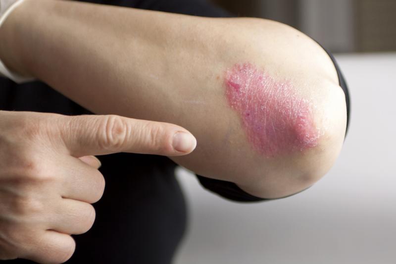 Biologics show promise in treatment of erythrodermic psoriasis