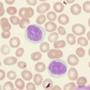 Primary Sjögren syndrome bidirectionally linked to non-Hodgkin lymphoma