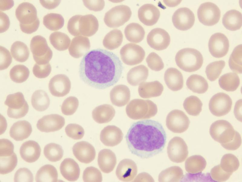 Post-treatment neutrophil, lymphocyte counts offer clues to Hodgkin’s lymphoma prognosis