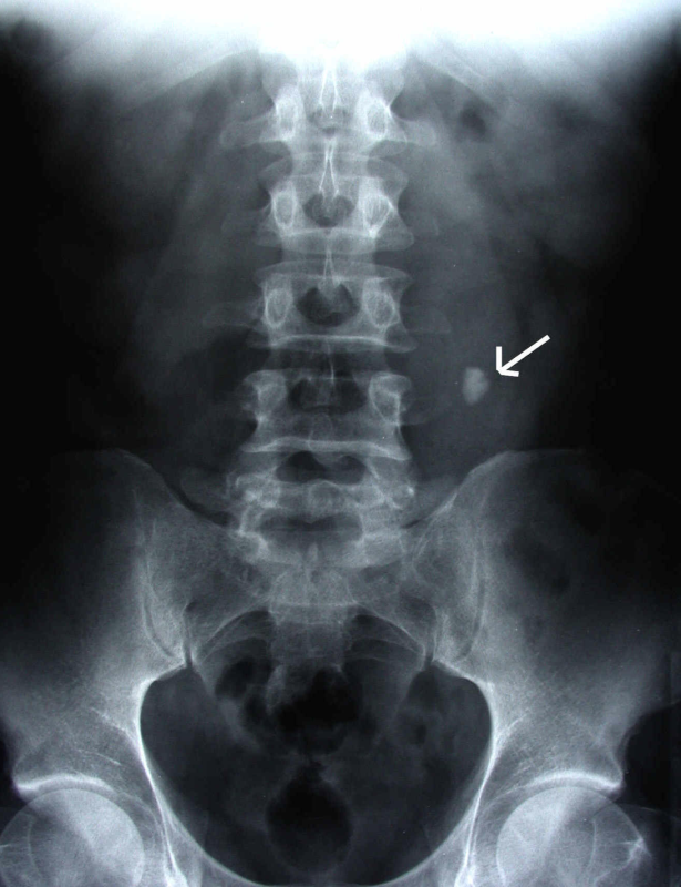 Radiograph reflecting a kidney stone. [Image courtesy of NUH]