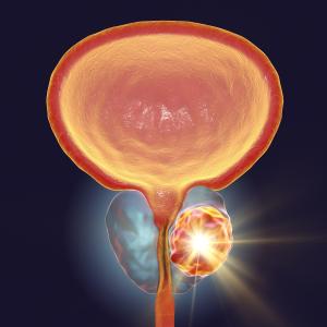 Docetaxel without prednisone ineffective for preventing prostate cancer progression after RT