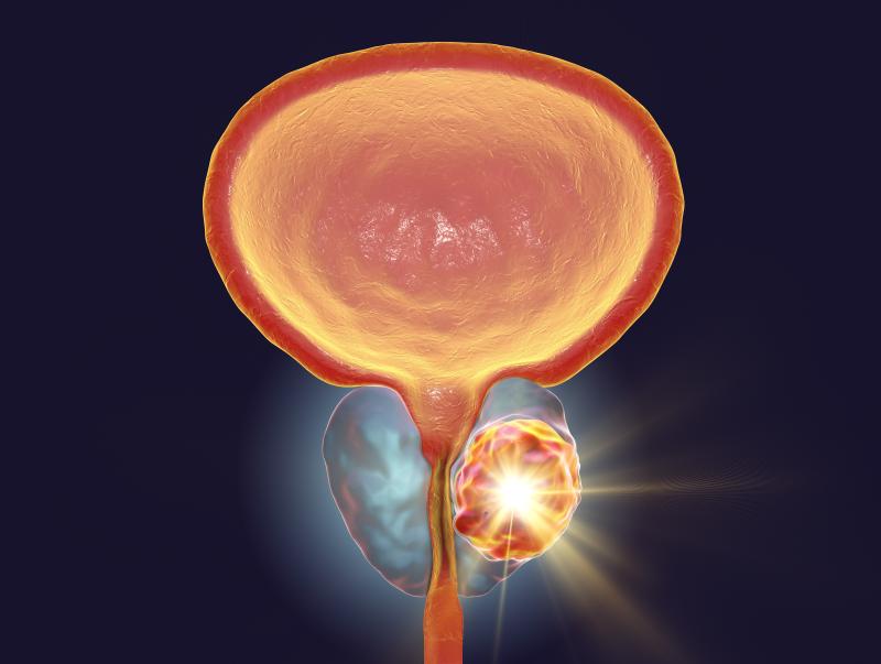 Docetaxel without prednisone ineffective for preventing prostate cancer progression after RT