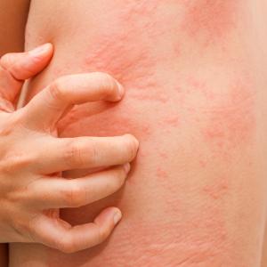 Itchy Rash (Urticaria) (Patient Counselling Guide)