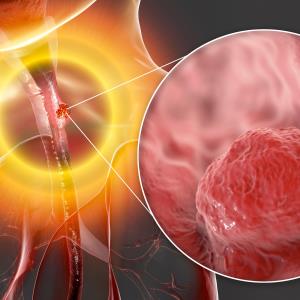 RATIONALE 302: Tislelizumab beats chemo in advanced ESCC