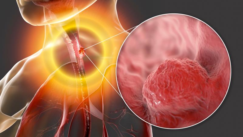 RATIONALE 302: Tislelizumab beats chemo in advanced ESCC