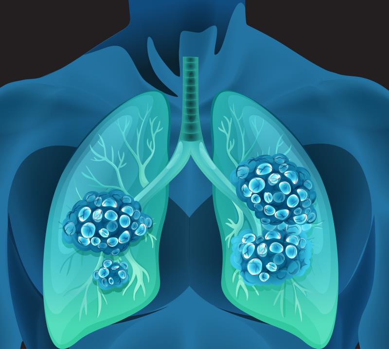 Tislelizumab-chemo a suitable first-line treatment alternative for advanced sq-NSCLC?