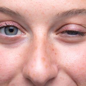 Ravulizumab shows rapid, sustained benefits for myasthenia gravis