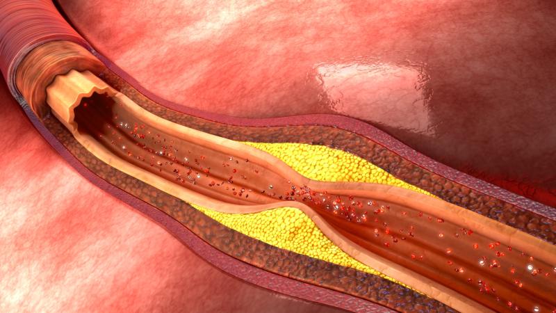 Colchicine helps prevent future cardiovascular events in CAD