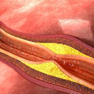 Real-world management of stable coronary artery disease