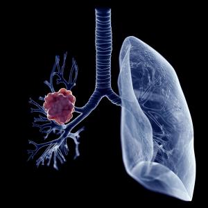 Amivantamab/lazertinib combo shows promise in EGFR-mutated NSCLC