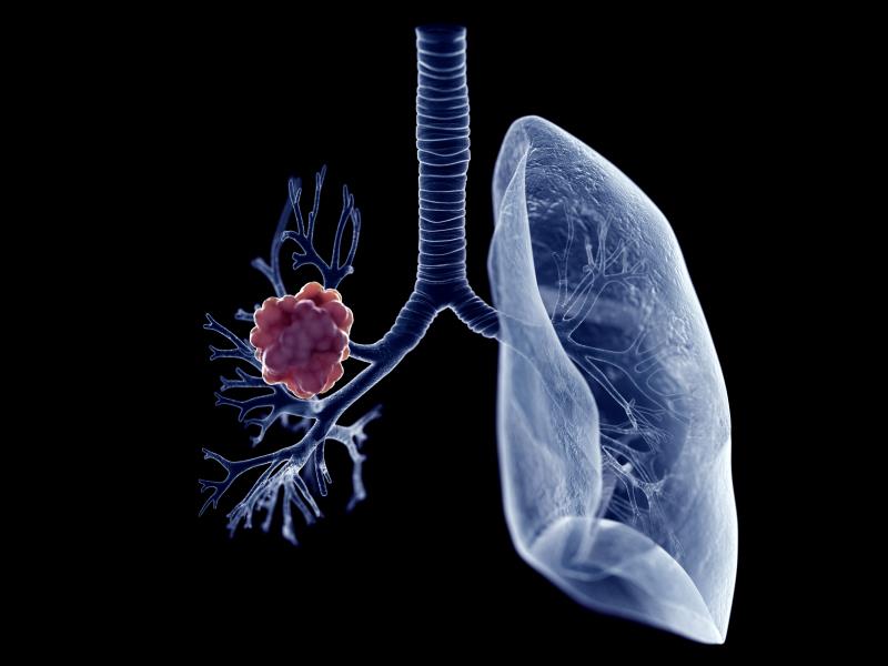 Acid suppression drugs counteract EGFR-TKIs for NSCLC treatment