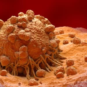 Melanoma diagnoses in 2020 tend to have thicker, more advanced tumours