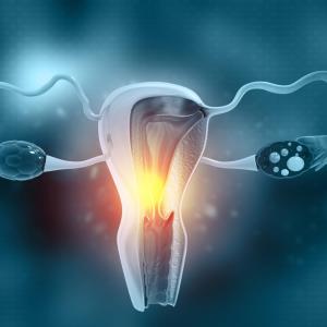 Reduction in endometriosis-associated pain sustained with relugolix combo therapy