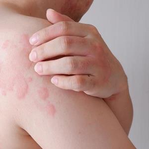 Remibrutinib offers rapid, sustained symptom relief in patients with CSU