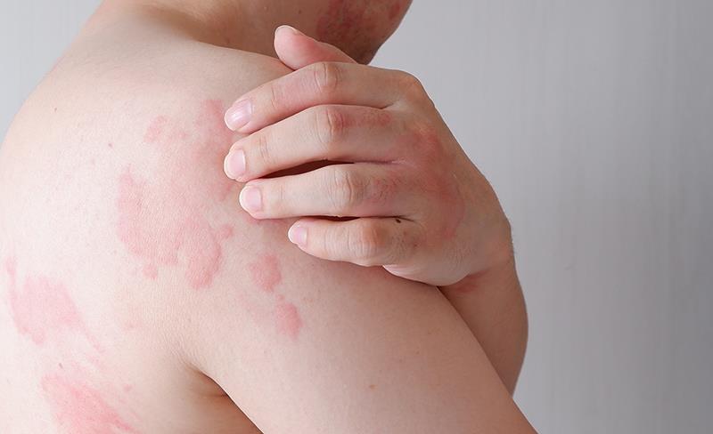 Remibrutinib offers rapid, sustained symptom relief in patients with CSU