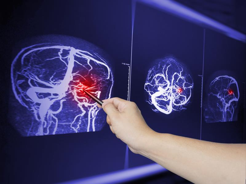 Repeat CT may be needed after head trauma in patients on older blood thinning meds