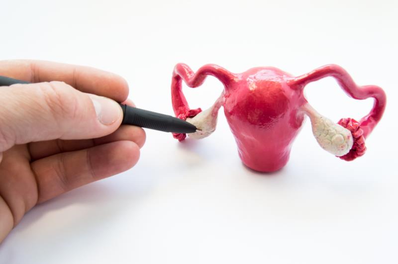 Administering hyperthermic intraperitoneal chemotherapy (HIPEC) during cytoreductive surgery for recurrent ovarian cancer hel