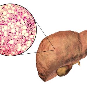 Resmetirom demos potential in NASH