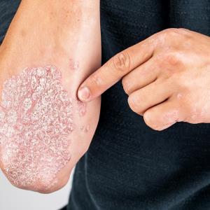 Experimental TYK2/JAK1 inhibitor shows promise against plaque psoriasis