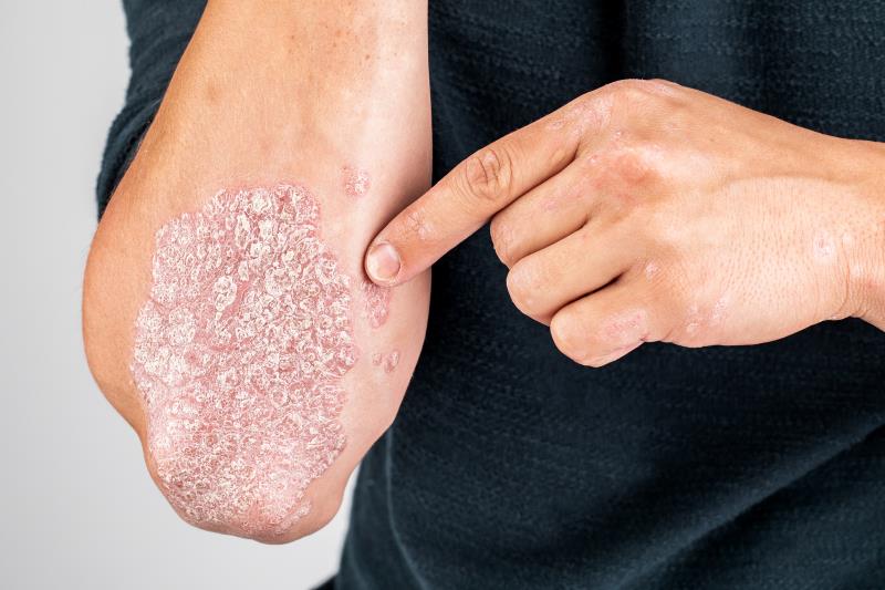 Experimental TYK2/JAK1 inhibitor shows promise against plaque psoriasis