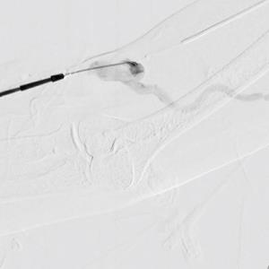 Sirolimus-eluting PTA balloons keep most complex infrainguinal lesions CD-TLR–free for a year