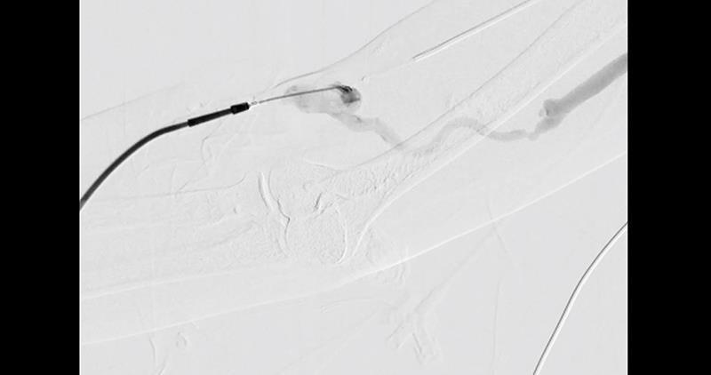Sirolimus-eluting PTA balloons keep most complex infrainguinal lesions CD-TLR–free for a year