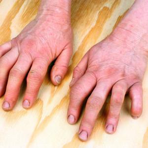 Add-on curcumin nanomicelle beneficial in rheumatoid arthritis treatment