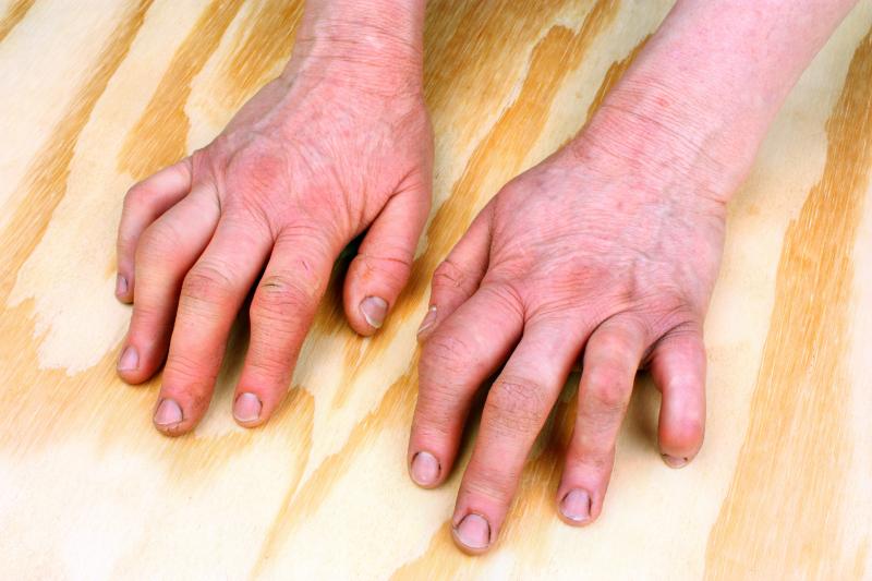 Add-on curcumin nanomicelle beneficial in rheumatoid arthritis treatment