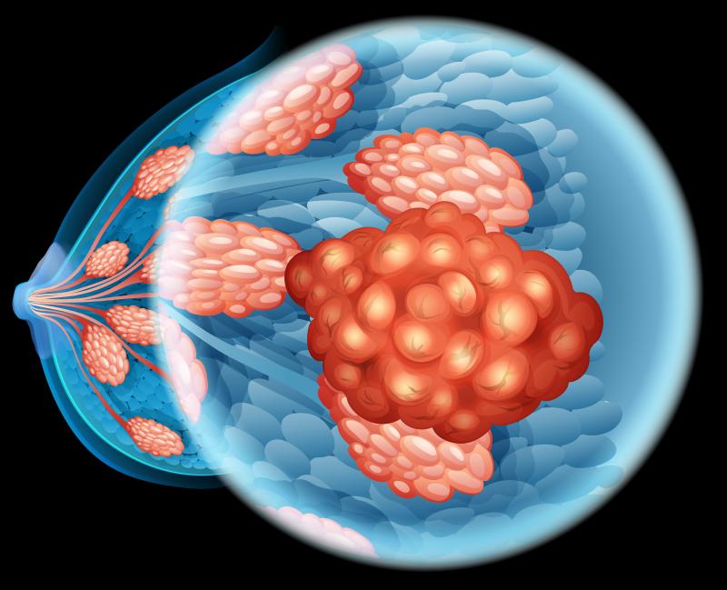 Add-on pyrotinib in neoadjuvant setting safe, effective for HER2-positive advanced breast cancer