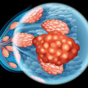 Palbociclib–bazedoxifene combo for HR+/HER2− breast cancer succeeds in early trial