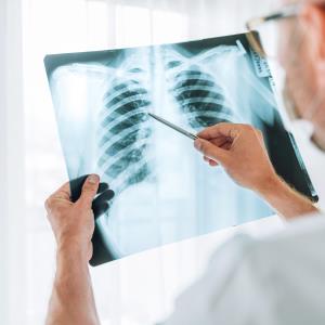 Shorter treatment regimen feasible for rifampin-resistant TB?